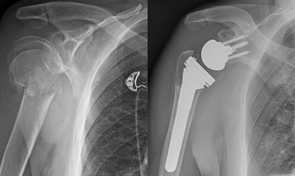 proximal humerus